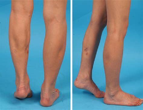 Severe Equinus Deformity After Radiofrequency-Induced Calf Muscle Reduction | Semantic Scholar