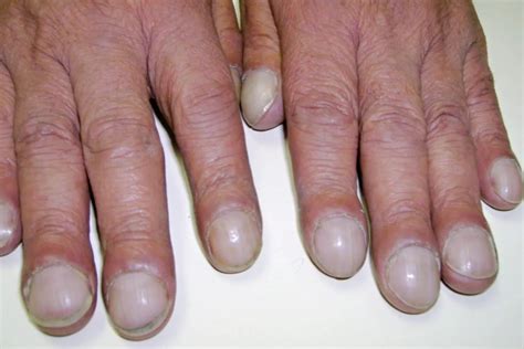 Clubbed Fingers and Nails: Causes and What They Look Like