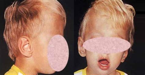 Macrocephaly: causes, symptoms and treatment