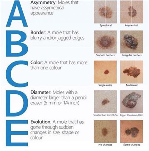 ABCDEs of Melanoma - Horizon Dermatology & Cosmetic Center - Horizon ...