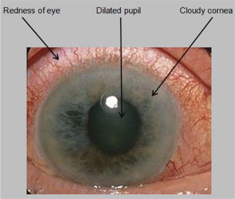 Pupillary Block and Angle Closure Glaucoma Flashcards | Quizlet