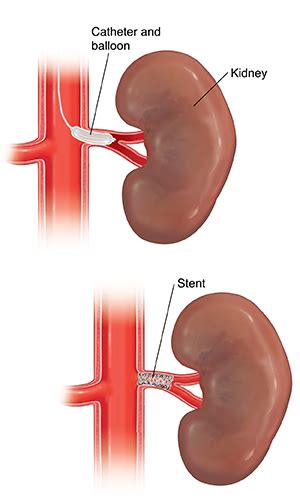 Renal Angioplasty and Stenting | Saint Luke's Health System