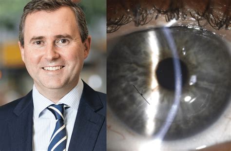 Australian-first keratoconus surgery performed in Brisbane - Insight