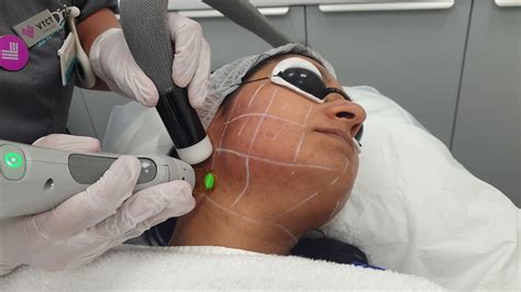 Performing Laser hair removal treatment on face. - YouTube