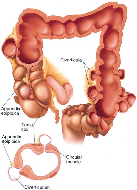 Top Diet Foods: Diverticulitis Diet Foods To Avoid