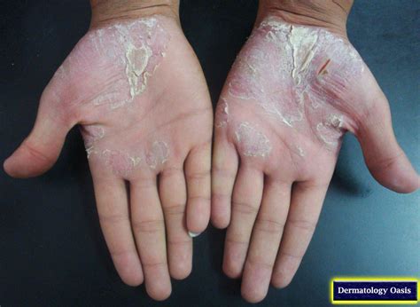 palmar psoriasis - pictures, photos