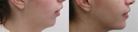 Before and After | Pittsburgh Orthodontic Group