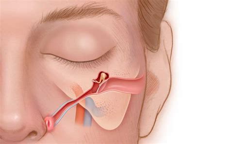 Eustachian tube dysfunction (ETD) and how to treat it