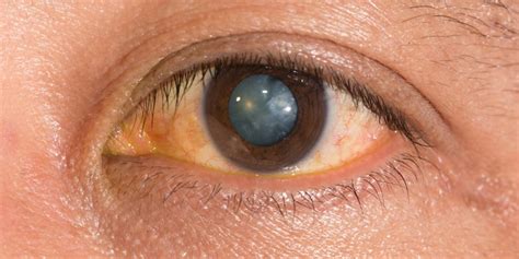 Congenital Cataracts In Adults