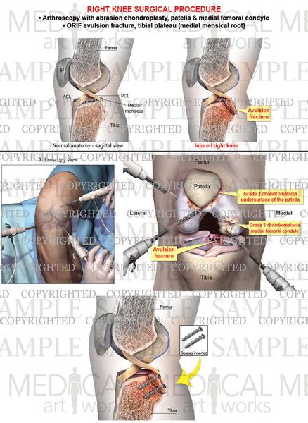 Right Knee Arthroscopy - ORIF avulsion fracture - Chondroplasty ...