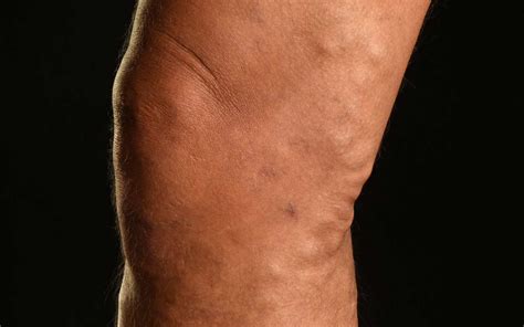 Inflamed Vein On Top Of Foot Deals | emergencydentistry.com