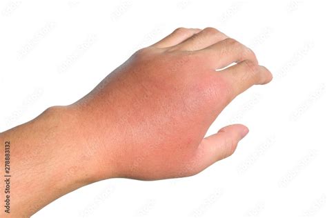 Inflammation, swelling, redness of the hand shows infection. Insect ...