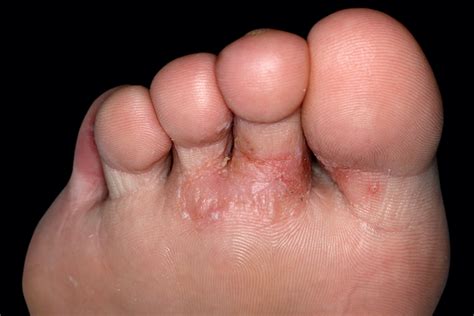 Bumps On Arch Of Foot That Itch Clearance | emergencydentistry.com