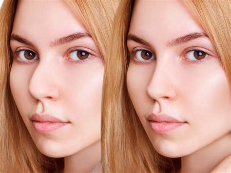 Fix Pollybeak Deformity with Rhinoplasty | Miami, FL