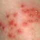Staph Infection: Causes, Contagious, Symptoms, Treatment, and Pictures - HubPages