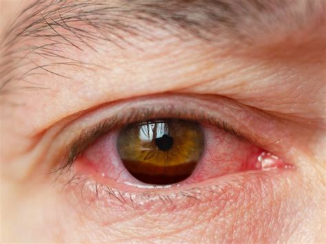 Hyphema (Bleeding in Eye): Diagnosis, Symptoms & Causes