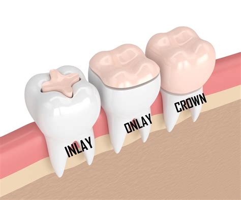 crown tooth procedure after root canal