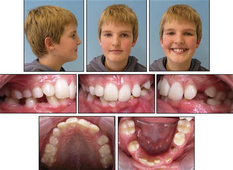 Regional odontodysplasia: Orthodontic treatment and transplantation of premolars | Pocket Dentistry