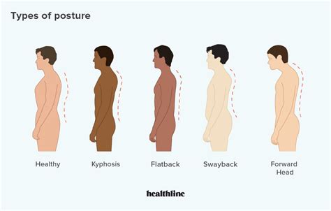 Types of Posture: How to Correct Bad Posture | Better posture, Bad posture, Forward head posture