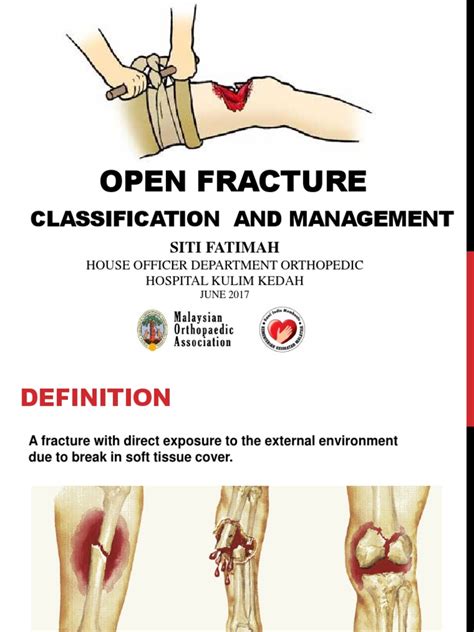 Open Fracture and It’s Classification and Management Siti | Orthopedic Surgery | Diseases And ...