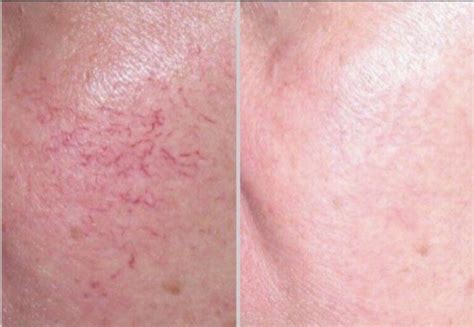 Laser Treatments for Rosacea - Frisco, Texas Laser Spa