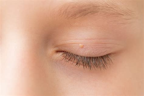 Eyelid Skin Tags: Causes And Treatment All About Vision, 46% OFF