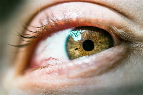 What is Iritis and How is it Treated? | Eye Contact