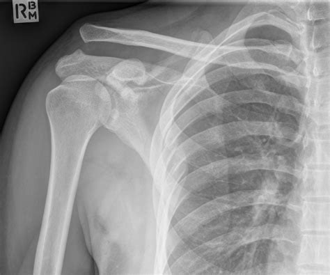 File:Scapular fracture, rib fractures and acromioclavicular joint dislocation (Radiopaedia 39440 ...