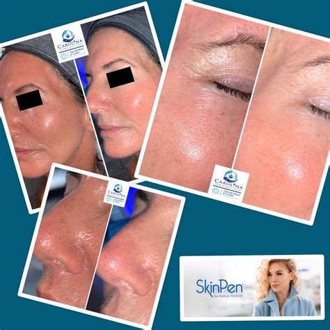 Skinpen - Carolina Hormone and Health