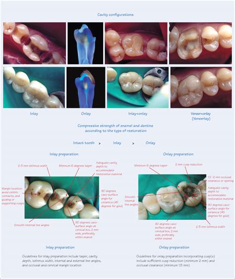 35 Preparation for inlays and onlays | Pocket Dentistry