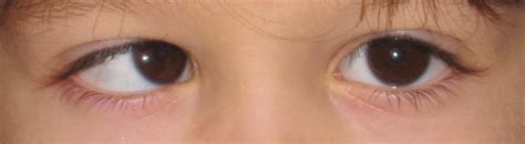 Esotropia (Crossed Eyes) - Pediatric Ophthalmic Consultants