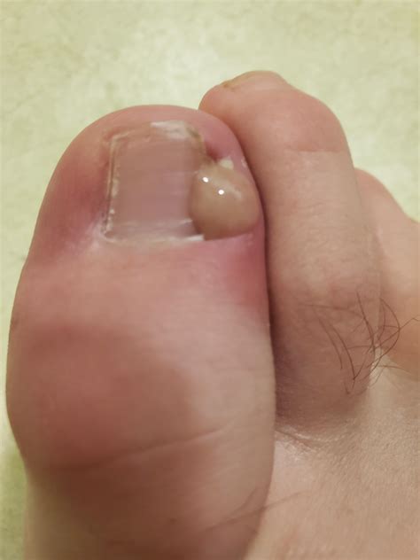 Ingrown toenail infection pop : r/popping