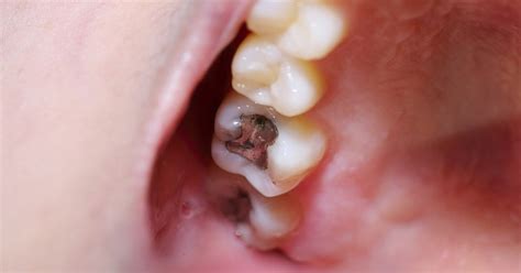 Pain After Cavity Filling: What You Need to Know