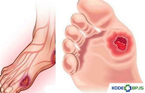 √ Kode ICD 10 Ulkus Diabetikum : Penyebab & Pengobatan - Kodebpjs.com