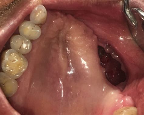 New artificial, fixed teeth and jaw after treatment of Black fungus (mucormycosis) of jaw at ...