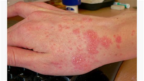 Brilliant Tips About How To Get Rid Of Scabies - Pricelunch34
