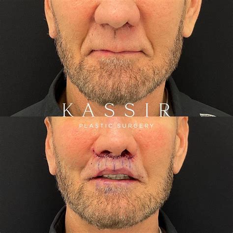 Kassir Plastic Surgery Blog — Kassir Plastic Surgery in NY and NJ