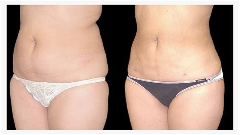 Liposuction Scars: How to Treat and Minimize Them