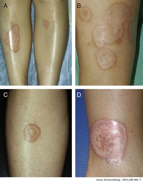 Necrobiosis Lipoidica: A Descriptive Study of 35 Cases | Actas Dermo ...