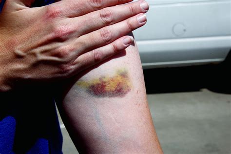 Unexplained bruises: causes, treatment and prevention – Mitch's Pool Service