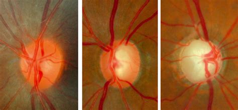 Normal optic disc and glaucomatous optic nerve heads | new-glaucoma-treatments.com