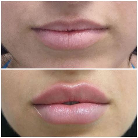 Marco Cosmetic Nurse Injector on Instagram: “1ml of lip filler 4 weeks follow up , repost from ...