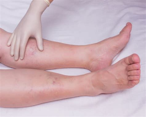Leg Edema Symptoms, Causes and More + PlusVitality