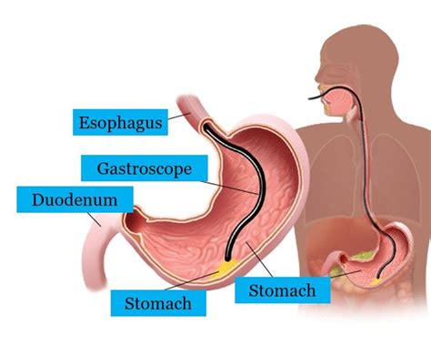 Gastroscopy in Singapore | Andrea Digestive Gastroenterology Clinic