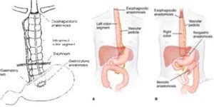 Delivery Following Colon Interposition | Canadian pharmacy Viagra ...