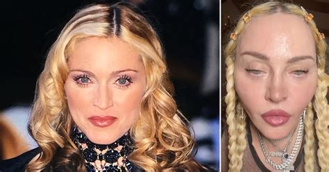 Madonna Before and After Plastic Surgery Journey: What Did She Do to Her Face?