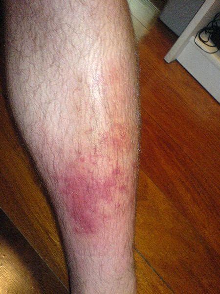 What is Cellulitis? Cellulitis Infection, Cellulitis Pictures ...