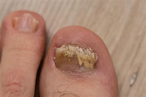 Toenail Fungus Causes | Prevention |Treatment | - Onychomycosis