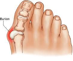 Alleviate Foot Pain and Discomfort Caused By Bunions | OrthoFeet