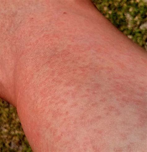 A Dermatologist Can Determine The Cause Of A Rash – EadvVienna2020.org